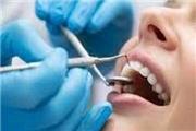 جرم گیری دندان خوب است یا بد ؟