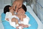 جداسازی خواهران دو قلو در بیمارستان نمازی شیراز